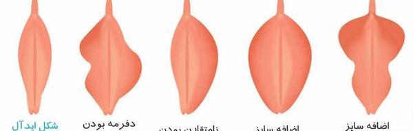 برداشتن لابيا عکس های واقعی عمل لابیاپلاستی