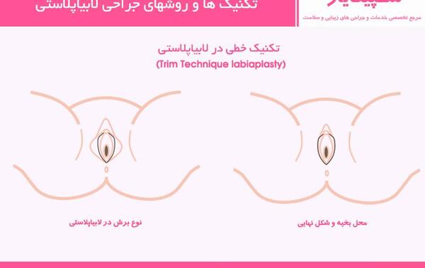 برداشتن لابيا عکس های واقعی عمل لابیاپلاستی