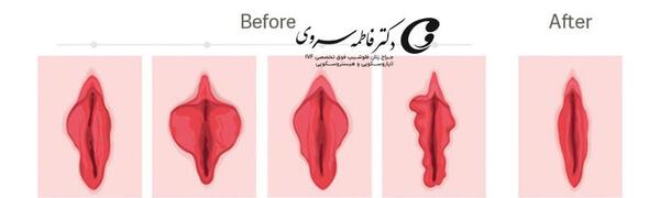 برداشتن لابيا عکس های واقعی عمل لابیاپلاستی
