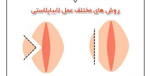 برداشتن لابيا عکس های واقعی عمل لابیاپلاستی