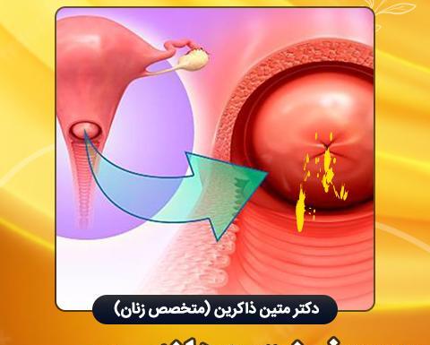 عکس عفونت رحم