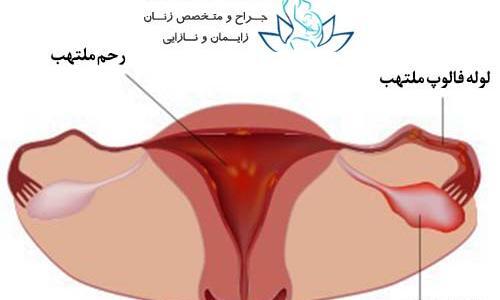 عکس عفونت رحم