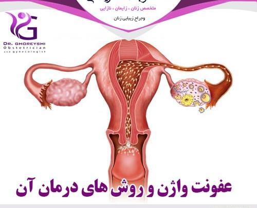عکس عفونت رحم
