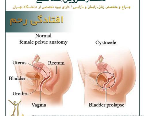 عکس رحم طبیعی