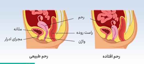 عکس رحم طبیعی
