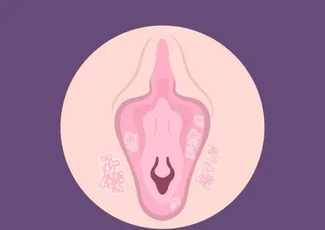 عکس جوش ناحیه تناسلی زنان