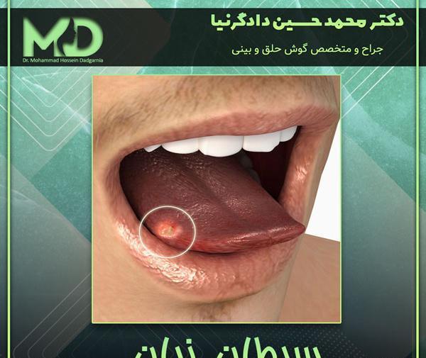 عکس زبان سرطانی