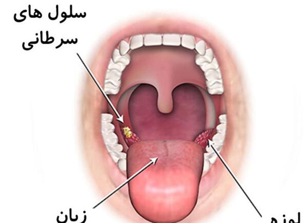 عکس زبان سرطانی