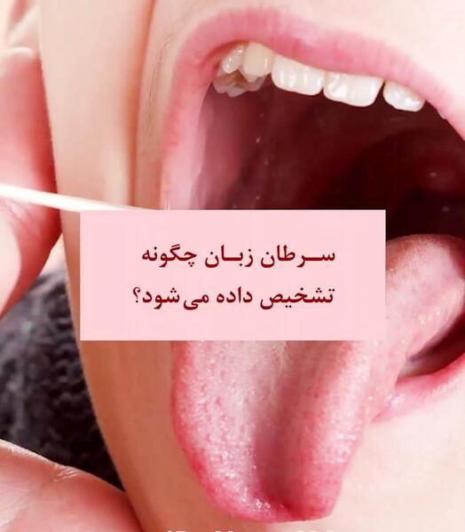 عکس زبان سرطانی
