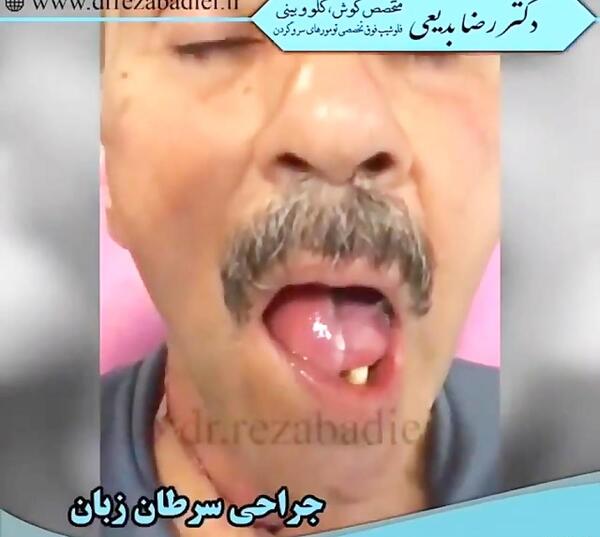 عکس زبان سرطانی