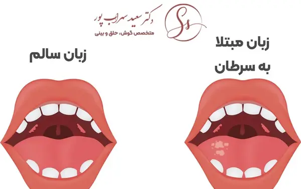 عکس زبان سرطانی