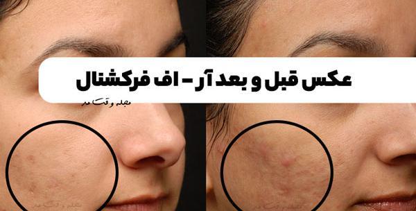 عکس قبل و بعد آر اف فرکشنال