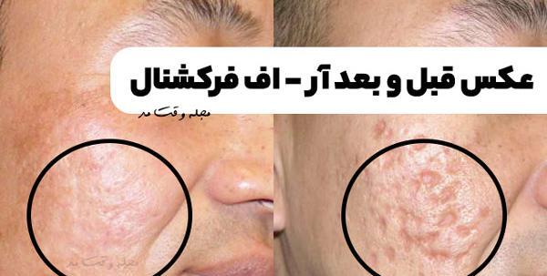 عکس قبل و بعد آر اف فرکشنال