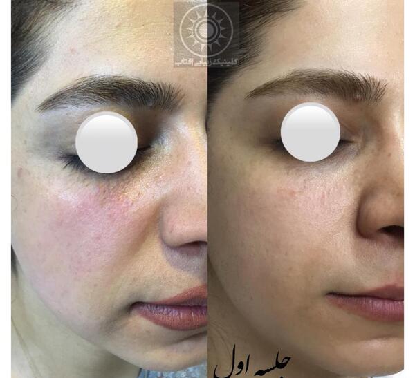 عکس قبل و بعد آر اف فرکشنال