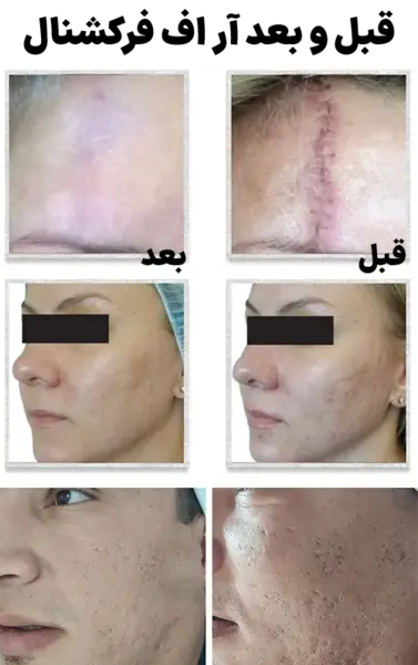 عکس قبل و بعد آر اف فرکشنال