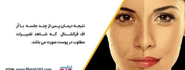 عکس قبل و بعد آر اف فرکشنال
