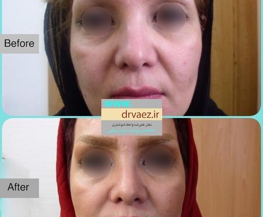 عکس قبل و بعد آر اف فرکشنال