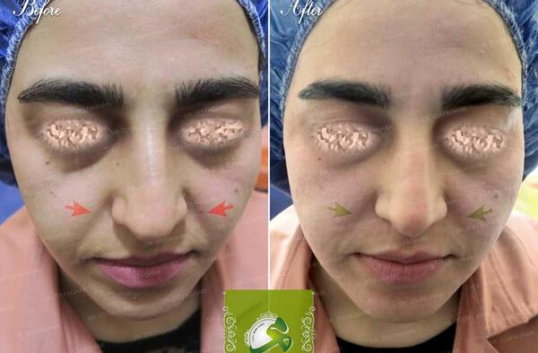 عکس قبل و بعد آر اف فرکشنال