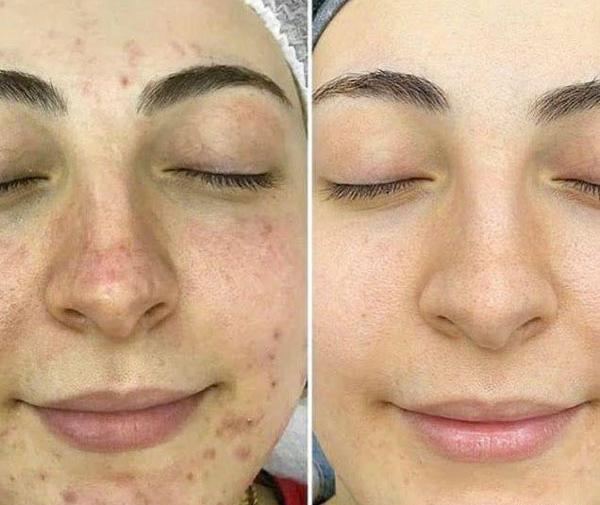 عکس قبل و بعد آر اف فرکشنال