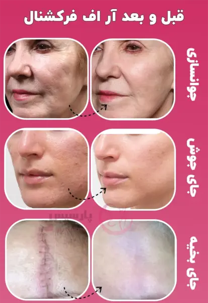عکس قبل و بعد آر اف فرکشنال