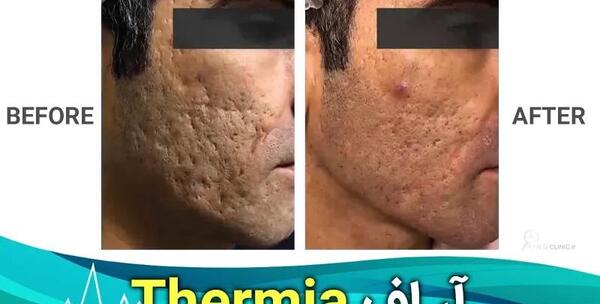 عکس قبل و بعد آر اف فرکشنال