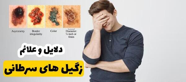 عکس زگیل سرطانی