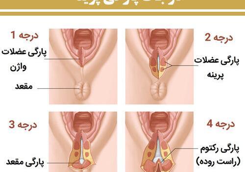 عکس بخیه زایمان طبیعی