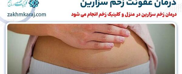 عکس بخیه زایمان طبیعی