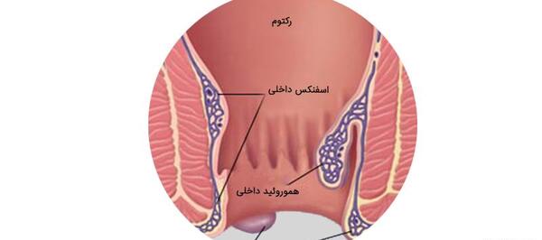 عکس بواسیر خارجی