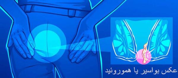 عکس بواسیر خارجی