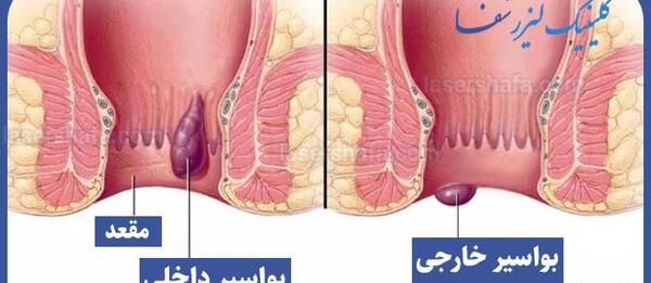 عکس بواسیر خارجی