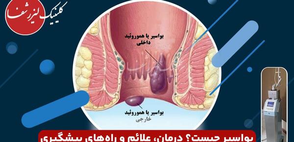 عکس بواسیر خارجی