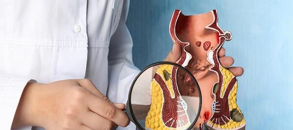 عکس بواسیر خارجی