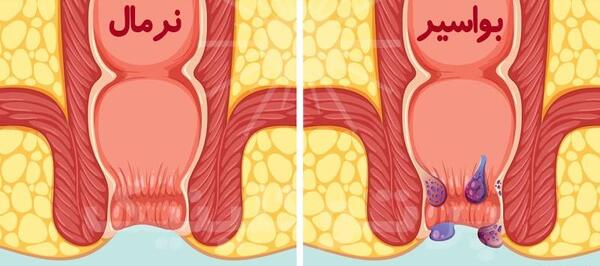 عکس بواسیر خارجی