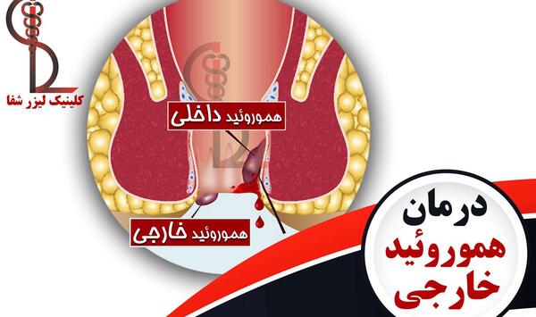 عکس بواسیر خارجی