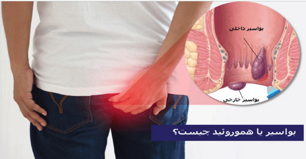 عکس بواسیر خارجی
