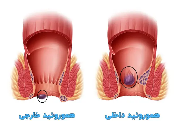عکس بواسیر خارجی