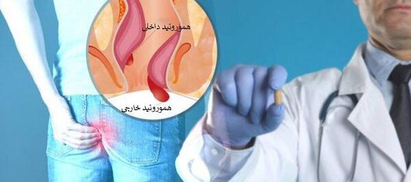 عکس بواسیر خارجی