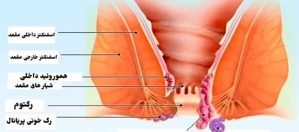 عکس بواسیر خارجی