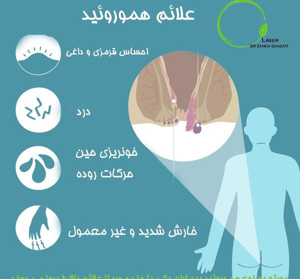 عکس بواسیر خارجی