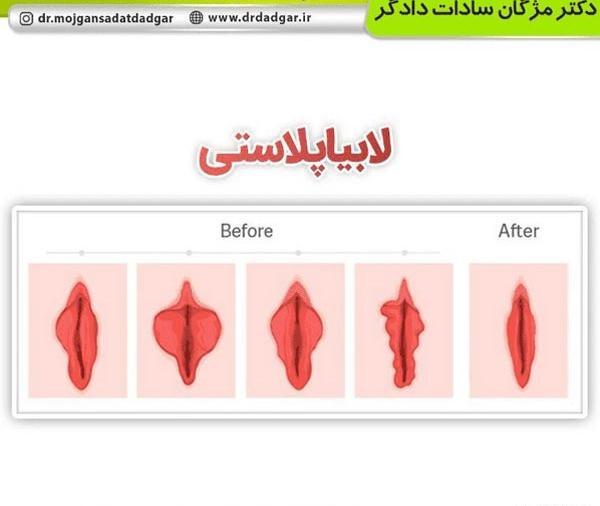 عکس های واقعی عمل لابیاپلاستی تهران، استان تهران، ایران