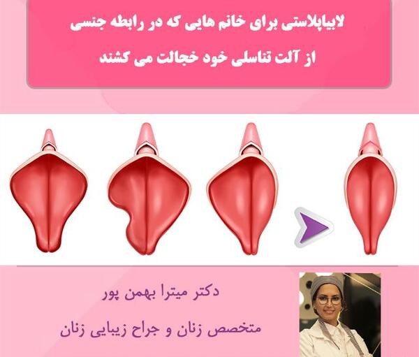 عکس های واقعی عمل لابیاپلاستی تهران، استان تهران، ایران