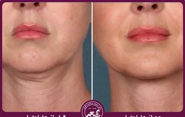 عکس قبل و بعد هایفوتراپی