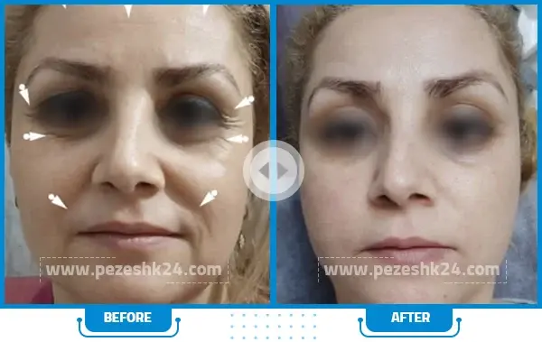عکس قبل و بعد هایفوتراپی