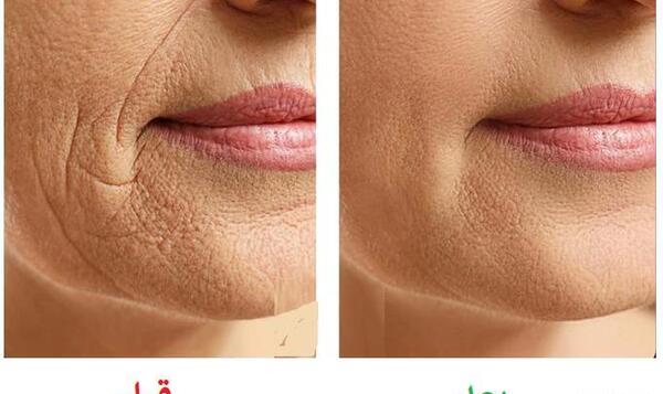 عکس قبل و بعد هایفوتراپی