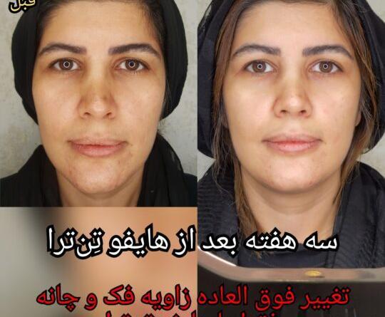 عکس قبل و بعد هایفوتراپی