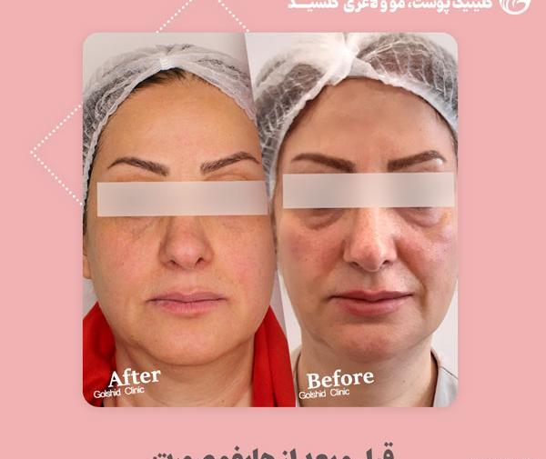 عکس قبل و بعد هایفوتراپی