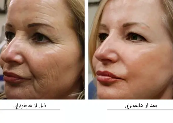 عکس قبل و بعد هایفوتراپی