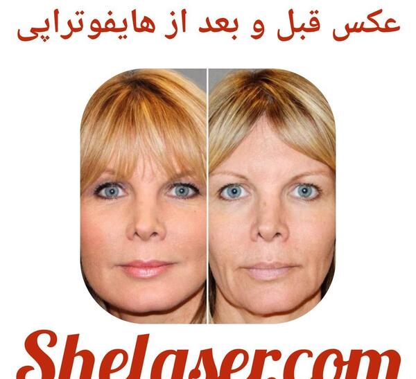 عکس قبل و بعد هایفوتراپی