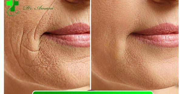 عکس قبل و بعد هایفوتراپی
